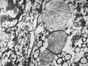 F,64y. | septate junctions between giant multivesicular bodies … uterus, stromal sarcoma